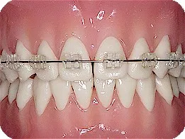 Clear ceramic braces