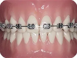 Silver metallic braces