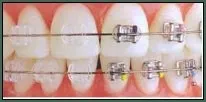 Metal and clear braces combined