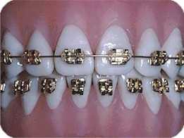 braces-gold.jpg