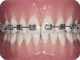 braces-silver.jpg