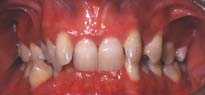 overbite