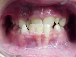 underbite