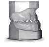 Class 3 malocclusion
