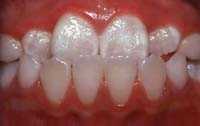 anterior crossbite