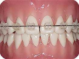 braces-clear.jpg