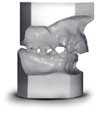 class 2 malocclusion